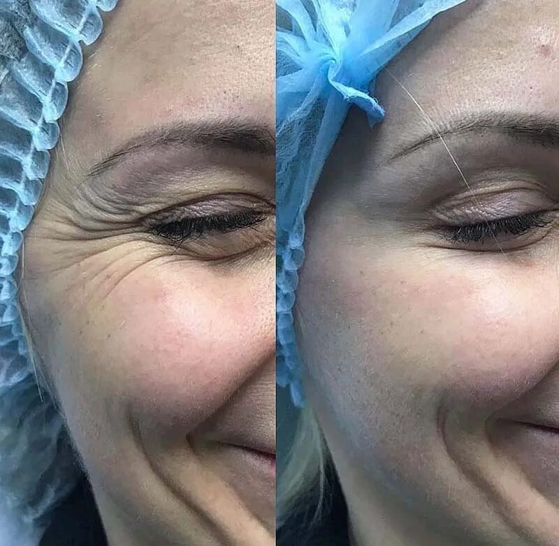 Ботулинотерапия гусиных лапок. Ботокс под глаза. Ботокс до и после. Ботокс для лица до и после. Ботулинотерапия от морщин skinlift ru