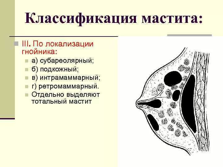 Ретромаммарный мастит. Мастит классификация по локализации. Локализация гнойных маститов. Ретромаммарный мастит локализация.