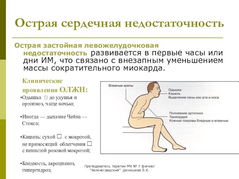 Застойная сердечная недостаточность