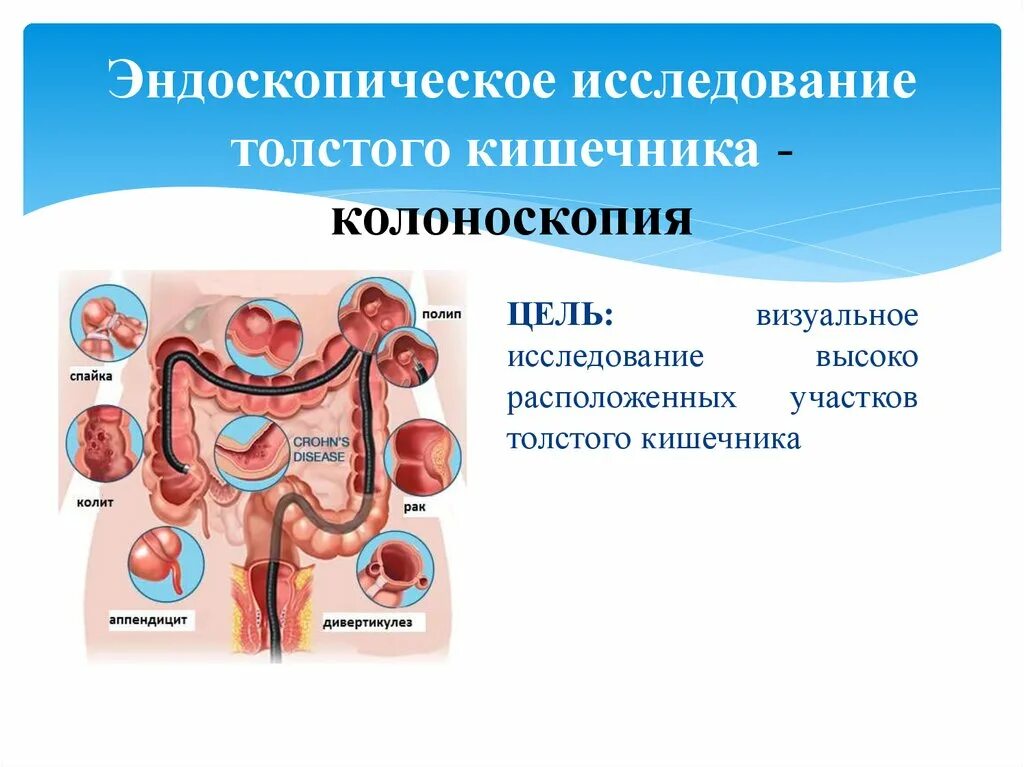 Исследование прямой и сигмовидной кишки. Эндоскопическое исследование Толстого кишечника. Эндоскопическое исследование толстой кишки колоноскопия. Эндоскопическое исследование Толстого кишечника кишки. Эндоскопическое исследование тонкого кишечника.