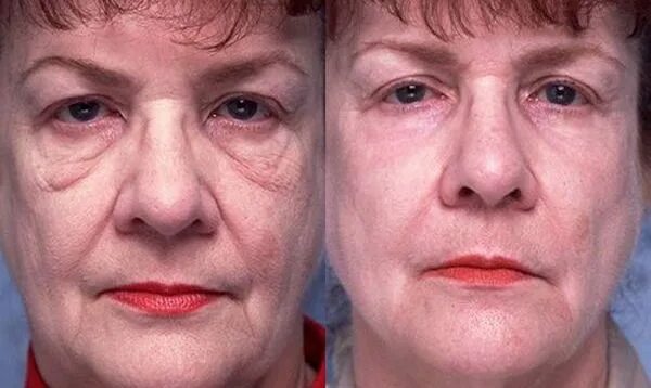 Глубокий пилинг до и после. Кожа после глубокого пилинга. Срединные пилинги (тса 10-20%). Феноловый пилинг до и после. Феноловый пилинг до и после.