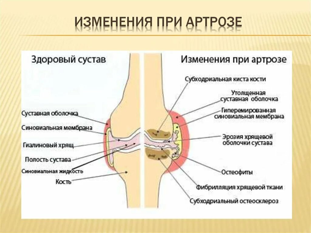 Артроз как помочь суставам. Артрит коленного сустава схема. остеоартроз презентация. изменения суставов при остеоартрозе.