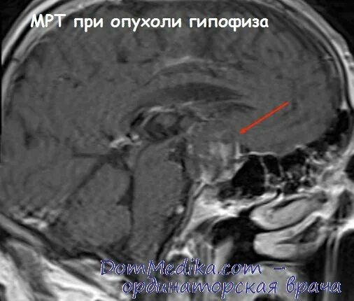 Мрт новообразование гипофиза. Хромофобная аденома гипофиза клиника. Опухоль гипофиза на мрт. Эндоселлярная аденома гипофиза.