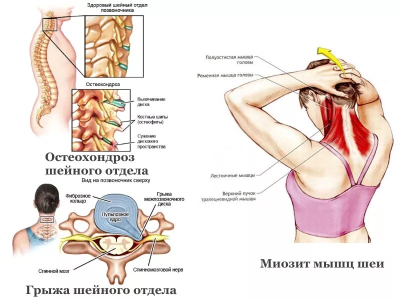 Анатомия и строение шейного отдела позвоночника. Схема позвонков шейного отдела позвоночника. Шейные отделы позвоночника с5 схема. Лечение остеохондроз плечевых