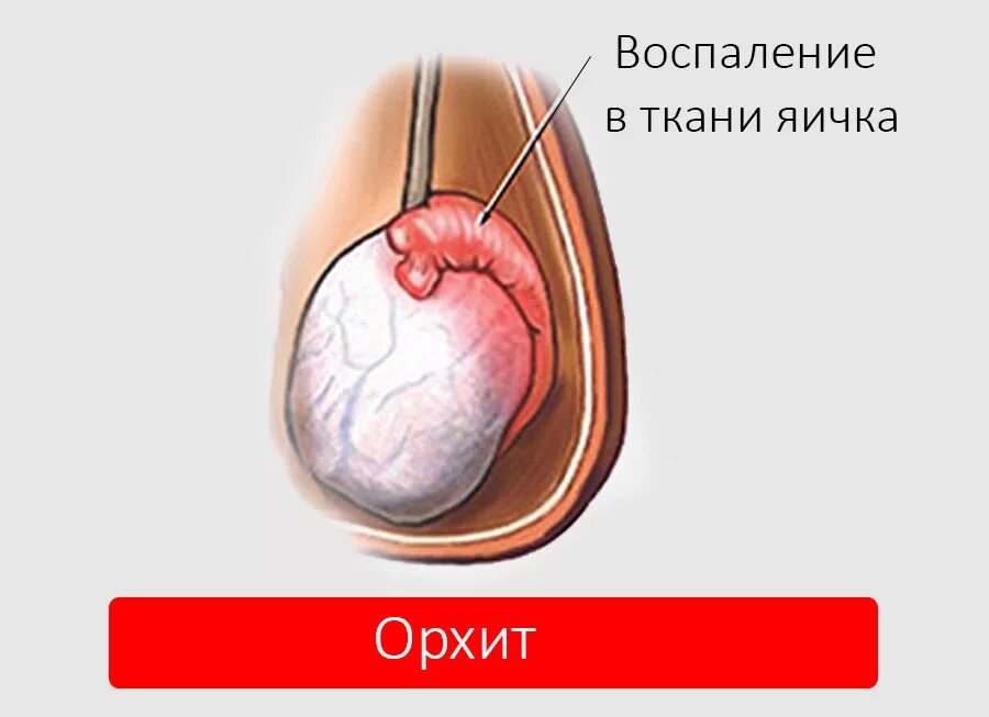 Придаток яичка сперматоцеле. Воспаление придатка яичка. Воспаление яичка у мужчин.