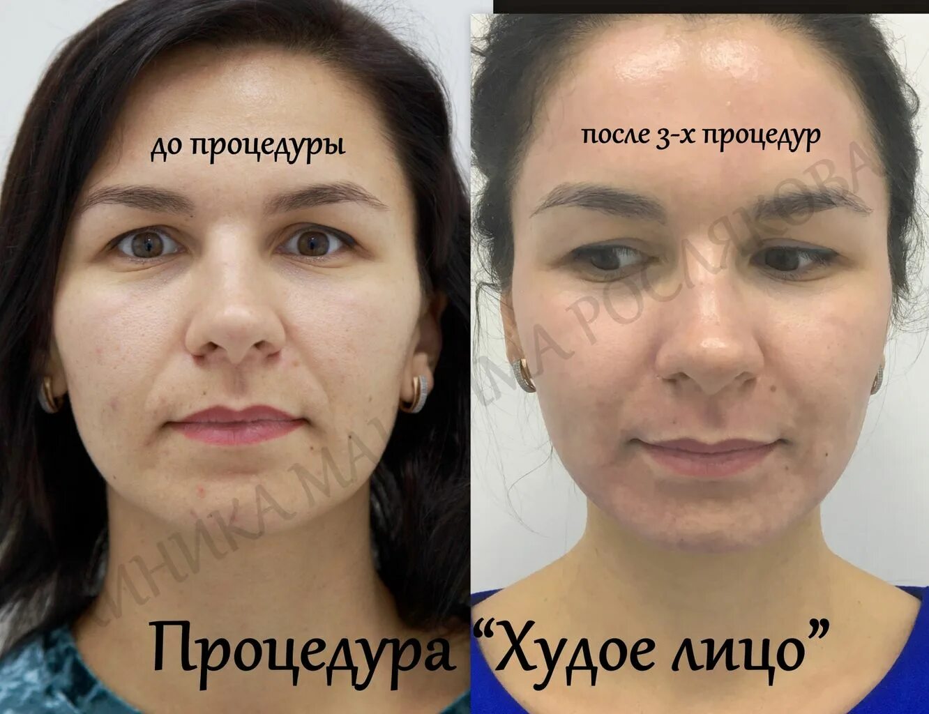 Худое лицо до и после Липолитики для лица до и после