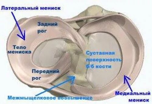 Повреждение медиального мениска 3 степени. Разрыв заднего рога медиального мениска 3 степени. Горизонтальный разрыв мениска. Повреждения медиального мениска 3а. Признаки дегенеративных изменений менисков