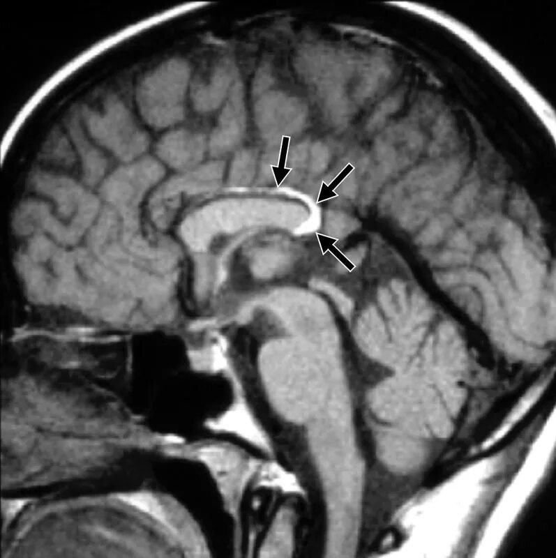 Киста головного мозга причины. Липома мозолистого тела мрт. Киста мозолистого тела мрт. Липома супраселлярной цистерны. Арахноидальная киста заднечерепной ямки кт.