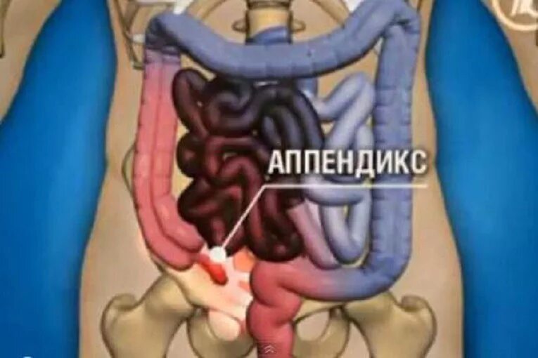 Аппендицит где находится сторона. Анатомия человека внутренние органы аппендикс. расположение аппендикса в брюшной полости. расположение аппендицита у человека. анатомия человека внутренние органы женщины аппендикс.
