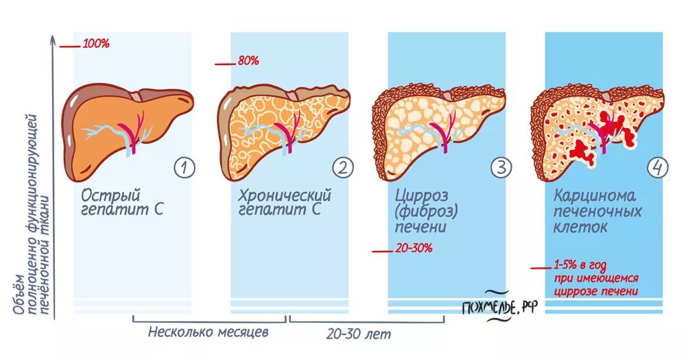 Печень в 3 года. Цирроз печени стадии развития. Изменения печени при циррозе.
