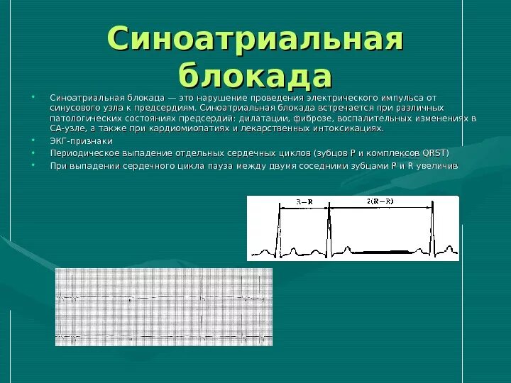 Блокада узла. Синоатриальная блокада 3 степени на ЭКГ. Синоатриальная блокада на ЭКГ признаки. ЭКГ критерии синоатриальной блокады. ЭКГ признаки синоатриальной блокады.