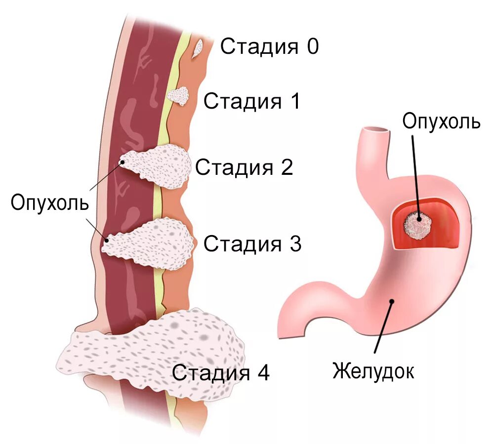 Новообразование в желудке. Злокачественное новообразование желудка.