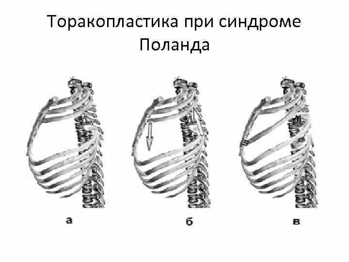 Синдром скользящего