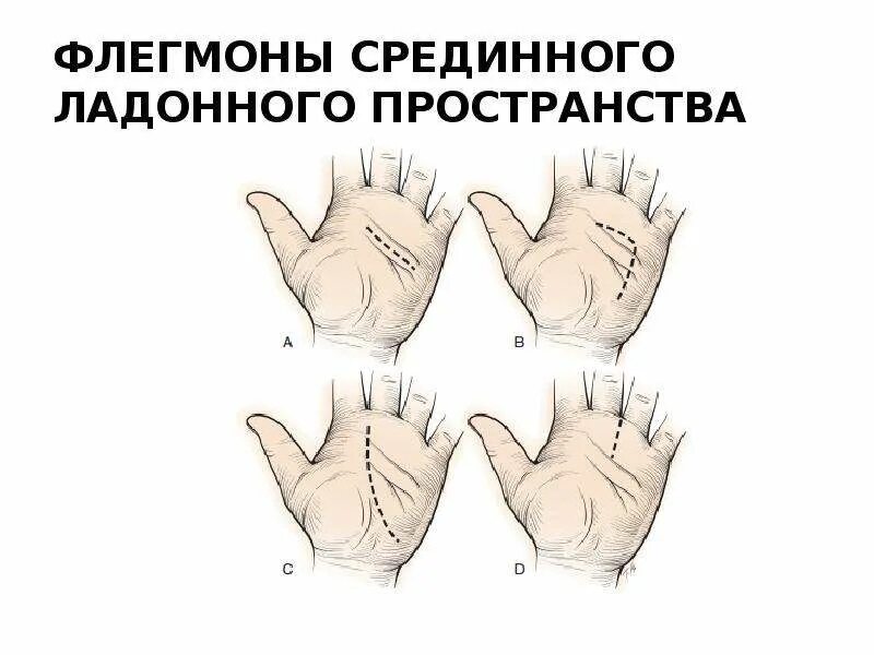 Линии разрезов при вскрытии флегмон предплечья. Флегмона срединного ладонного пространства. флегмоны кисти классификация. разрезы при флегмоне срединного ладонного пространства.