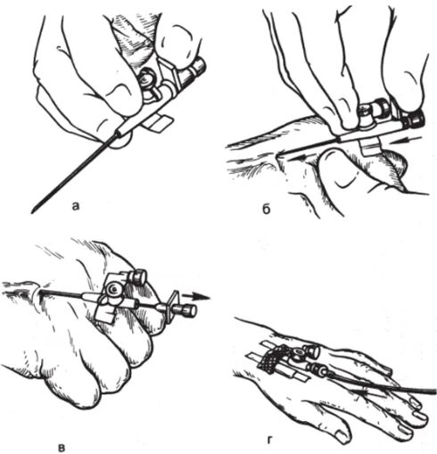 Катетер в вену алгоритм. Техника введения внутривенного катетера. Схема постановки катетера внутривенного. Техника постановки внутривенного периферического катетера алгоритм. Периферический катетер схема.
