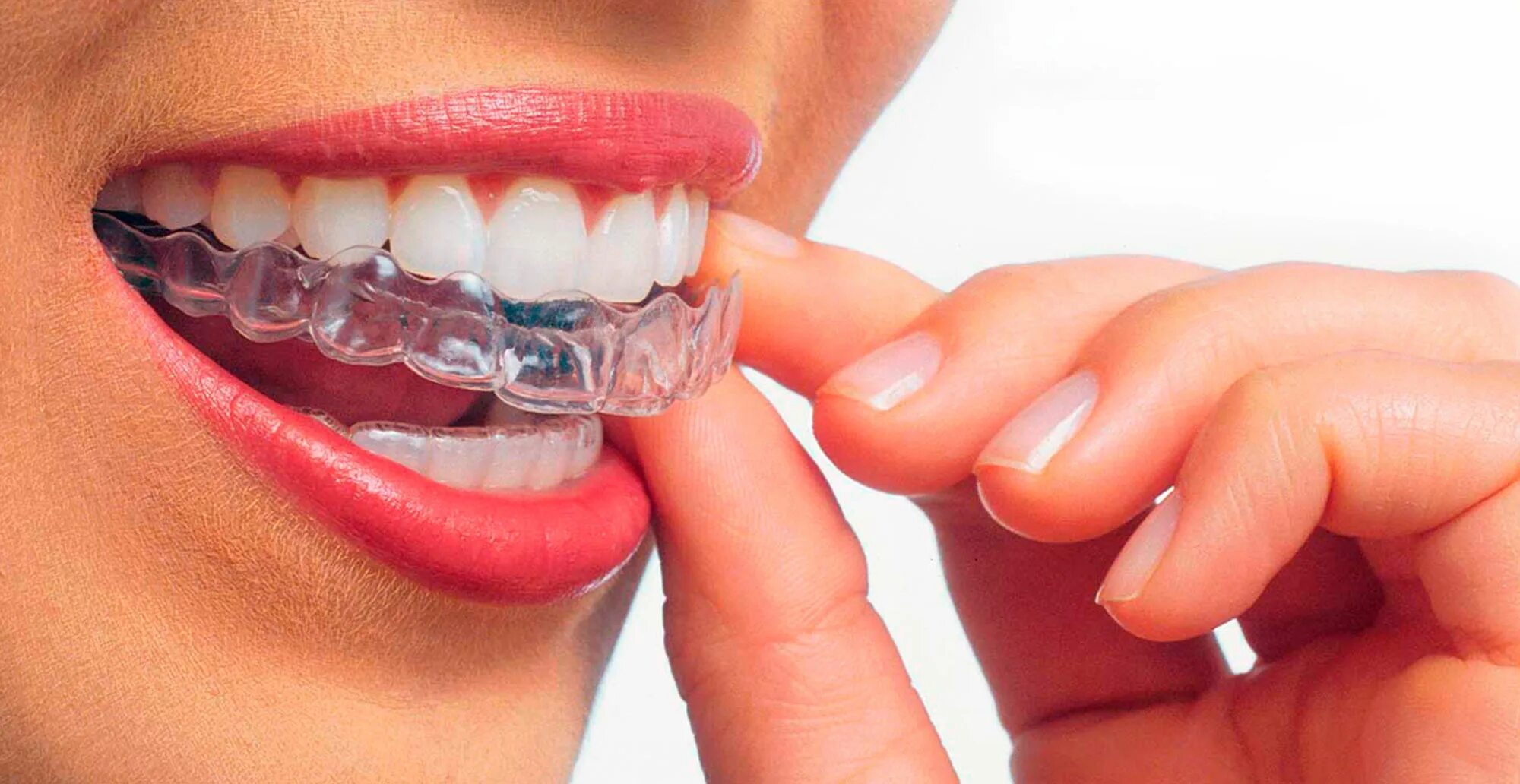 Элайнеры Invisalign. Ортодонтические каппы элайнеры. Ретенционная Каппа Инвизилайн.