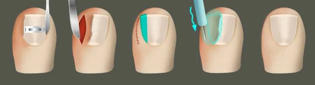 Врезаются ногти что делать. Онихокриптоз 2 степени. Операция вросшогоногтя.