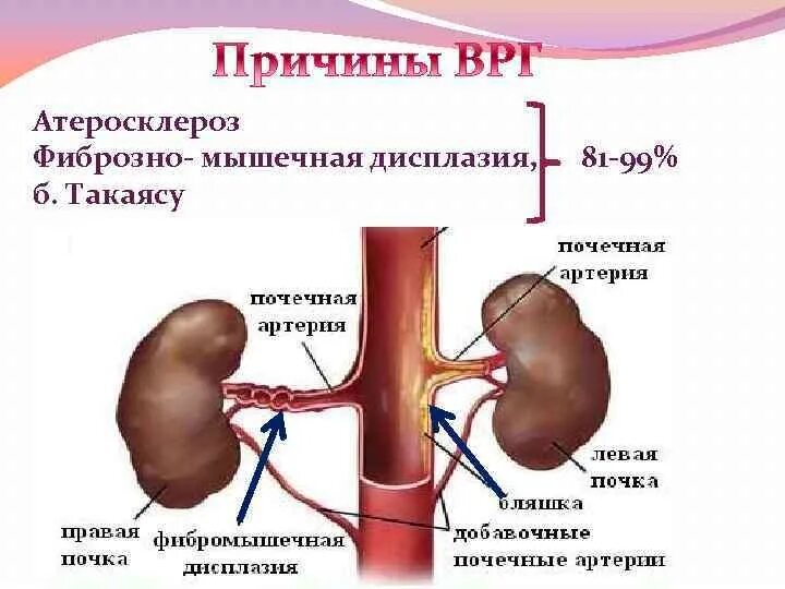Стеноз артерии почки. Фибромускулярная дисплазия почечных сосудов. фибромускулярная дисплазия почечной артерии. фибромышечная дисплазия почечных артерий. атеросклероз почечных артерий.