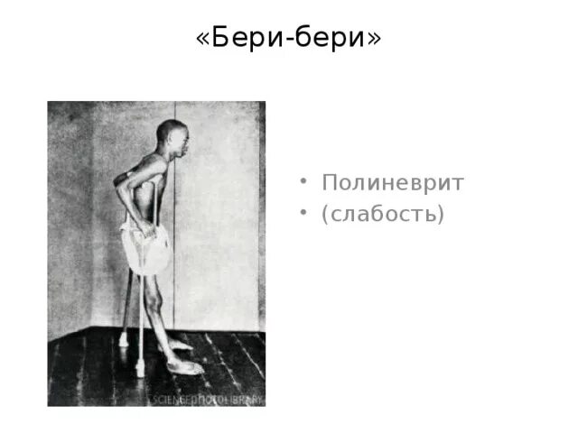 Витамин б бери бери. Недостаток витамина в1 бери бери. Полиневрит (болезнь «бери-бери»). Сердечная форма синдрома бери-бери. Болезнь бери-бери ( дефицит витамина в1).