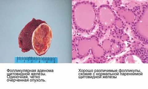 Щитовидная железа аденома операция