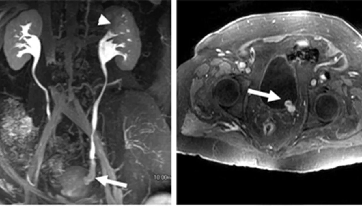 Обструкция мочеточника. Стриктура мочеточника на кт. Обструкция мочеточника опухолью. Стриктура мочеточника мрт.