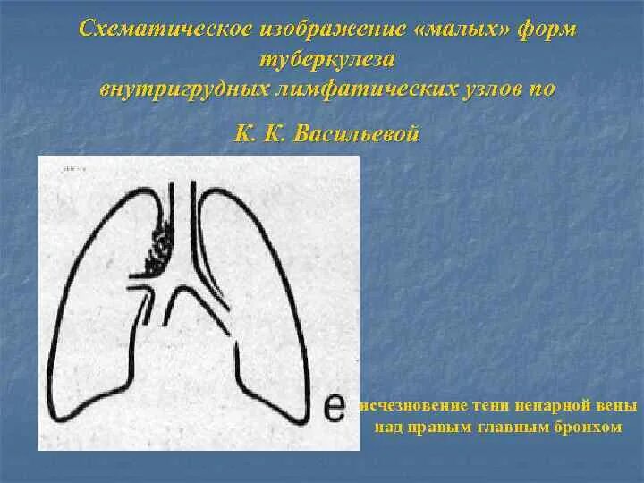 Бронхоаденит это