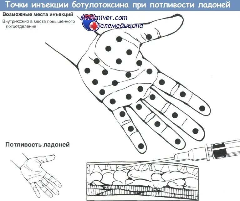 Гипергидроз ладоней схема. Гипергидроз ладоней ботокс схема введения. Ботокс при гипергидрозе ладоней. Точка уколова