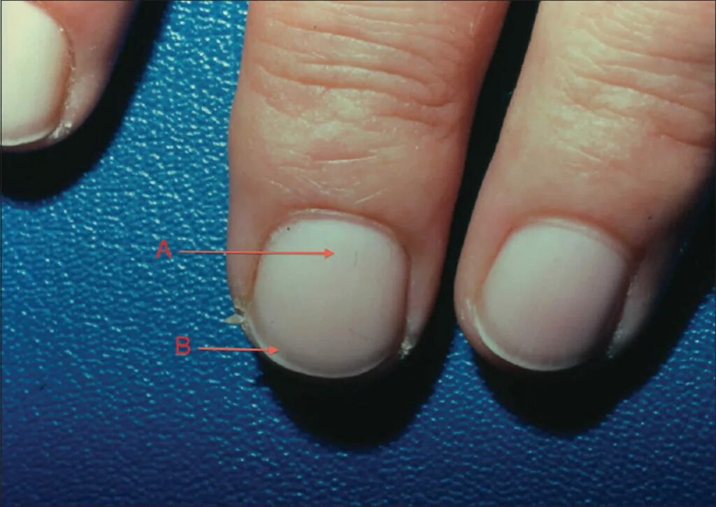 Ногти стали толстыми и твердыми. Поперечные линии на ногтях. Белая ногтевая пластина.