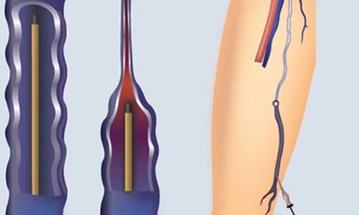 Эндовенозная лазерная коагуляция (ЭВЛК). Радиочастотная абляция варикоза. Удаление тромба цена