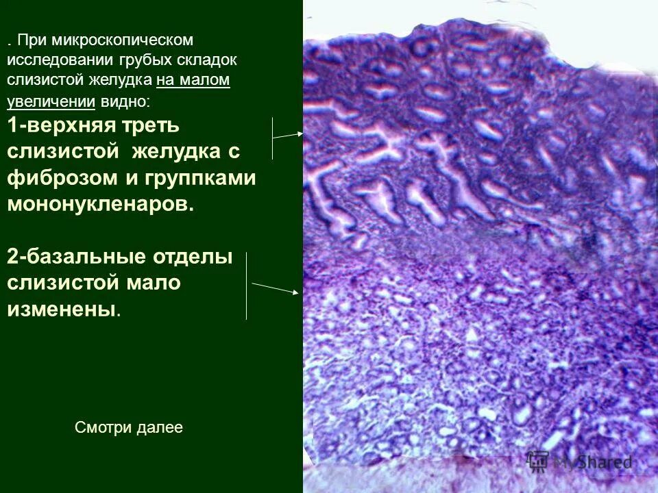 микроскопическое исследование желудочного содержимого. копрология кала микроскопия. микроскопия желчи лейкоцитоиды. клеточные элементы желчи. нейтрофилы в ликворе клетки.