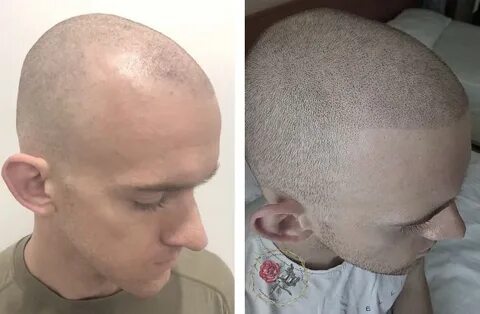 Сколько растут волосы после пересадки