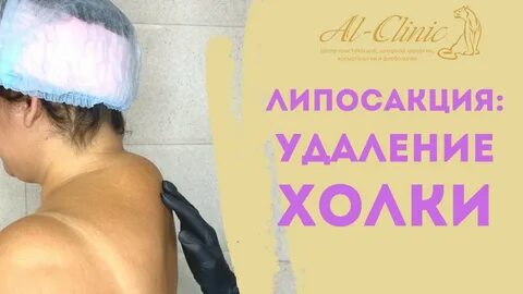 Вдовий горб липосакция отзывы