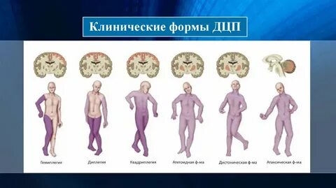 Какой формы дцп