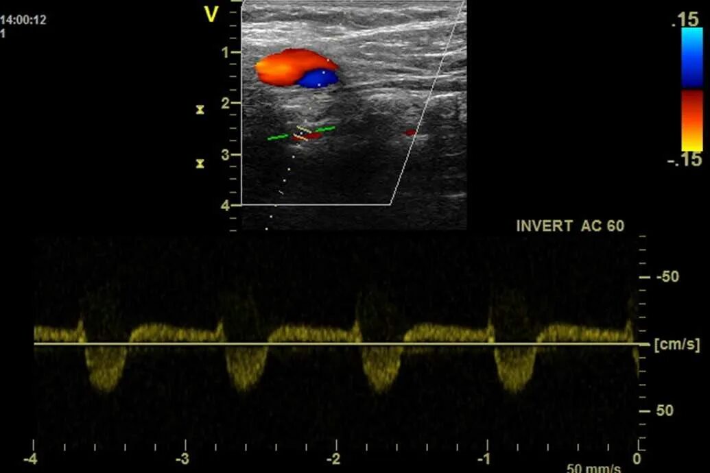 Что такое уздг. Ультразвуковое триплексное сканирование. УЗДГ дуплексное и триплексное сканирование. Ультразвуковое цветовое дуплексное сканирование. Триплексная сонография брахиоцефальных сосудов норма.