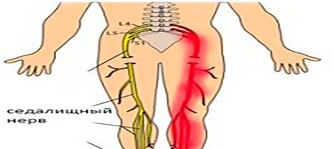 Седалищный нерв л5 с1. Хиджама на седалищный нерв. Седалищный нерв (sciatic nerve)? 011. Нервы в пояснице и седалищным нервом. Можно ли греть при защемлении