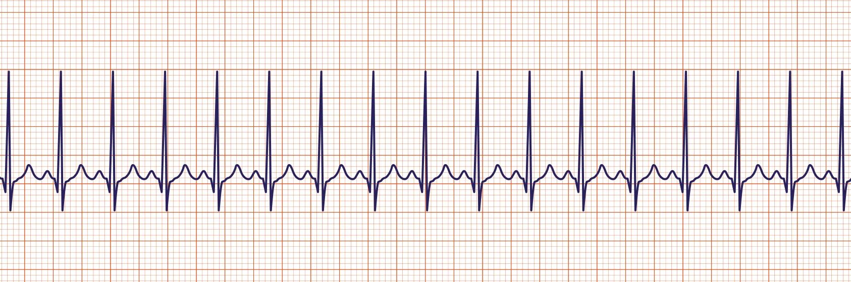 Учащенное сердцебиение тахикардия. Sinus tachycardia ECG. Sinus bradycardia ECG. Тахикардия картинки.