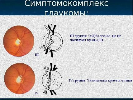 Диск зрительного нерва при глаукоме