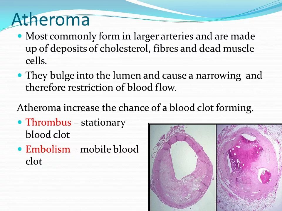 Common form. Mayo classification IVC thrombi. Definition of terms and Concepts for atheroma.