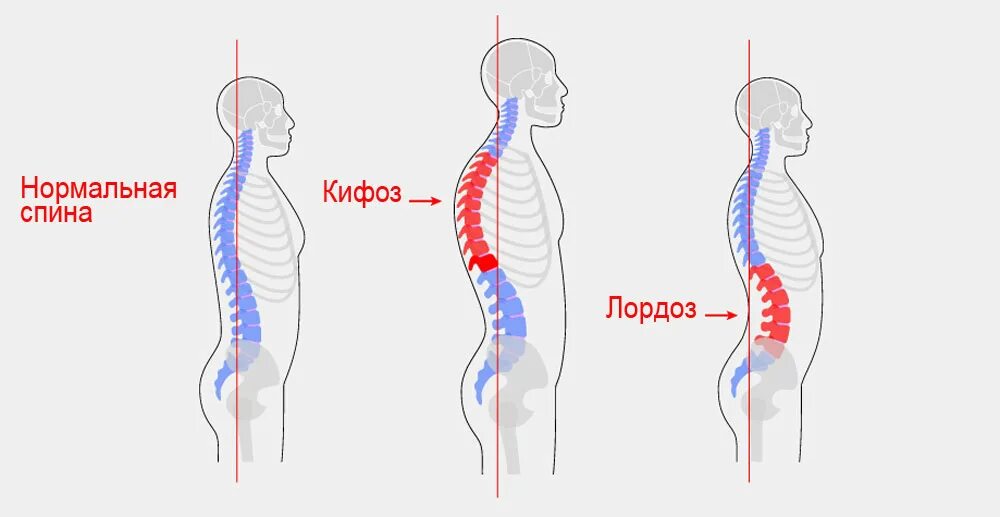 Усиленный лордоз. Лордоз грудного отдела позвоночника. Кифоз 1 степени грудного отдела позвоночника. Кифоз грудного отдела позвонка. Искривление грудного отдела позвоночника кифоз.