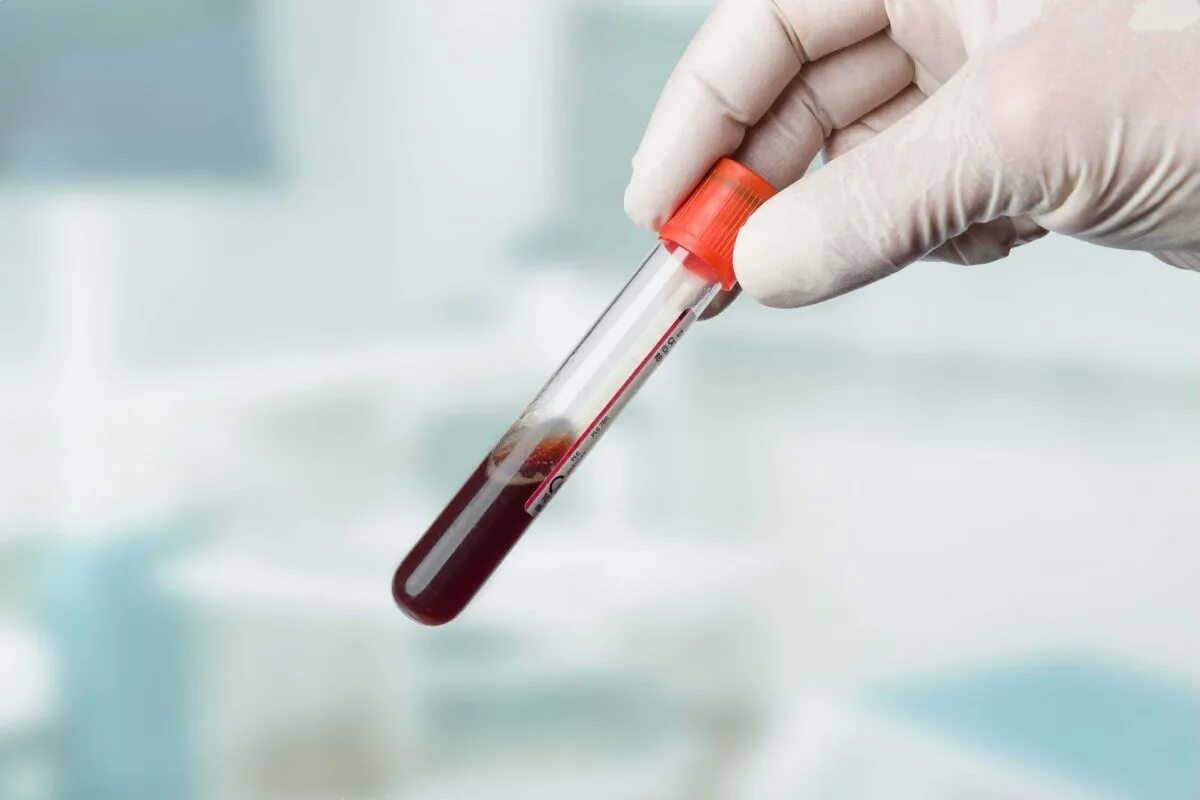 Қан алу. Исследование крови. Общее исследование крови. Пробирки исследования. Биохимическая пробирка для крови.