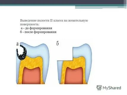 Наличие кариозных полостей