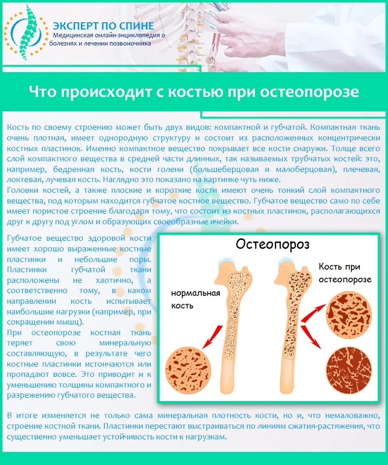Болезнь остеопороз как лечить. Остеопороз губчатого вещества. остеопороз лучевых костей. остеопороз трубчатой кости. остеопороз костей симптомы.