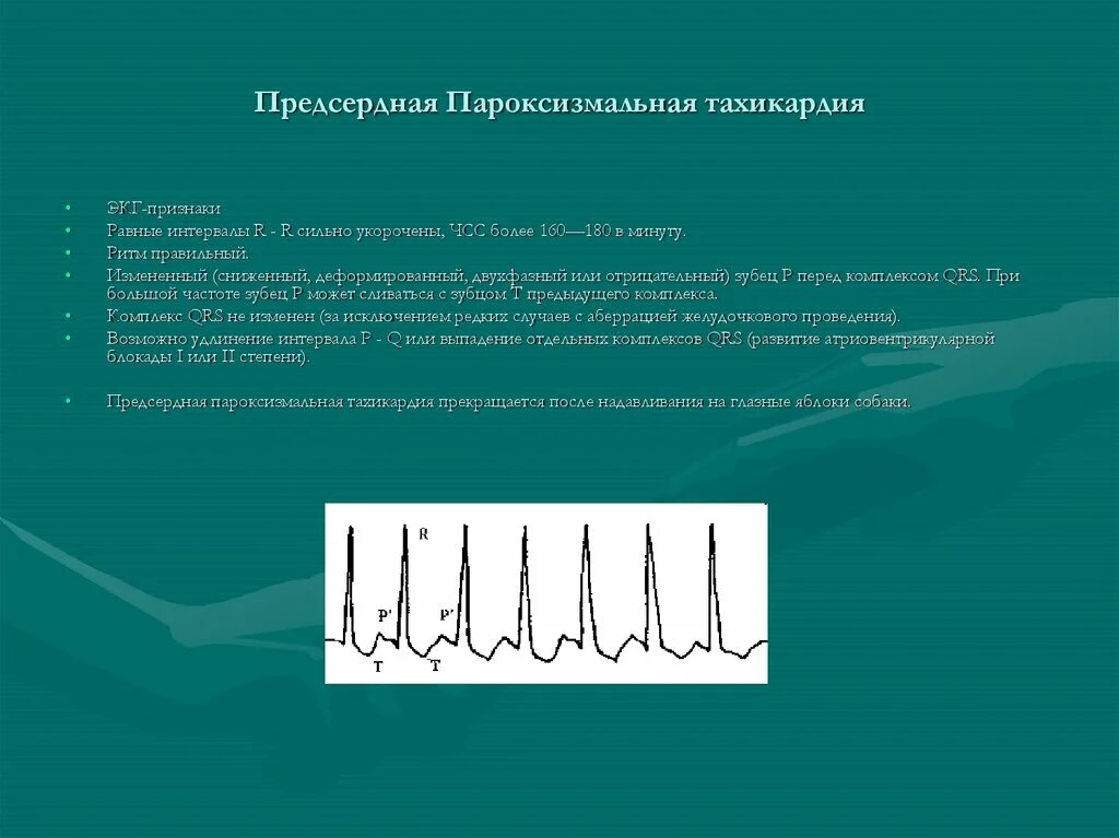 Предсердная тахикардия на ЭКГ признаки. Пароксизмальная тахикардия ЭКГ. Эктопическая пароксизмальная тахикардия. Многофокусная предсердная тахикардия на ЭКГ. Признаки тахикардия у женщины симптомы