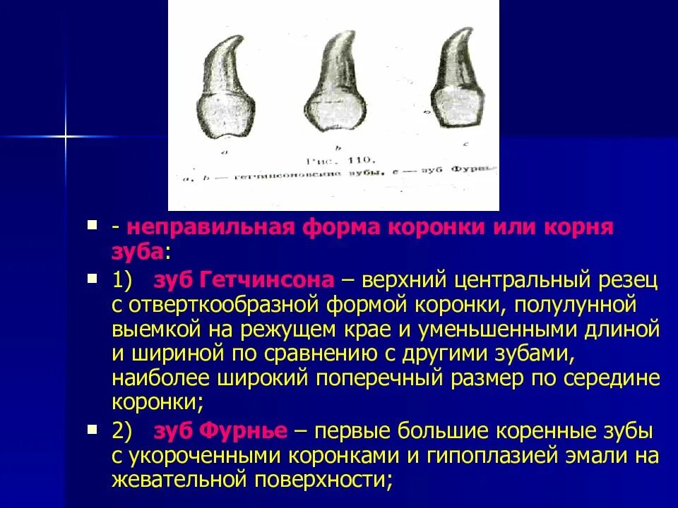 Режущий край коронок. Дистальный резец нижней челюсти. Композитные виниры кариес. Строение медиального резца верхней челюсти. Безметалловая керамика emax.