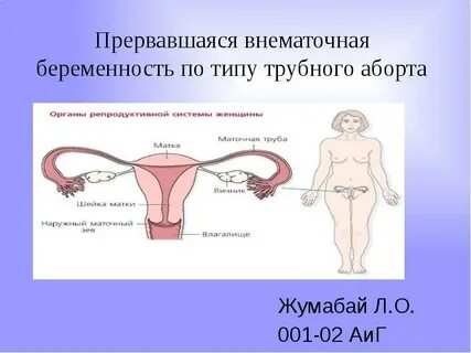 Внематочная беременность операция сколько