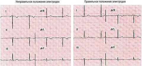Перепутанные электроды