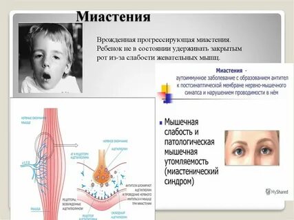 Миастения форум больных