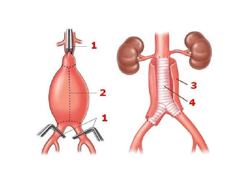 Аневризма брюшной полости операция. Аневризма брюшной аорты протез. Операции при аневризме брюшной аорты. Аневризма аорты брюшной полости операция. Аорта брюшной полости операция