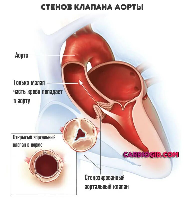 Сердечный стеноз. Стеноз аортального клапана. Стеноз отверстия аортального клапана. Порок сердца стеноз аортального клапана. Стеноз аортального клапана клапан.