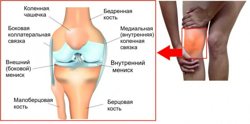 Болит ли мениск. Мениск коленной чашечки разрыв мениска. Медиальный мениск коленного сустава. Киста Бейкера анатомия коленного. Киста коленного сустава медиальная.